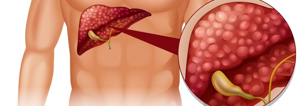 Лечение рака желчного пузыря в Израиле