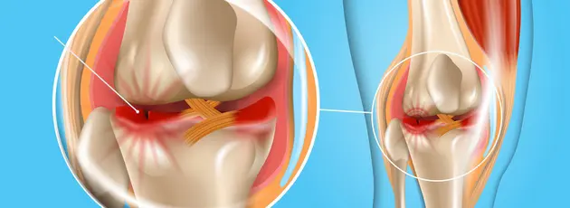 Лечение разріва мениска в Израиле