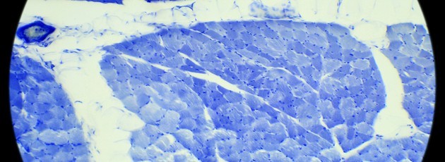Sarcoma treatment in Israel