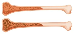 Лечение остеосаркомы в Израиле