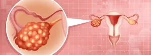 Ovarian cancer treatment in Israel