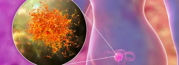 Uterine cancer treatment in Israel