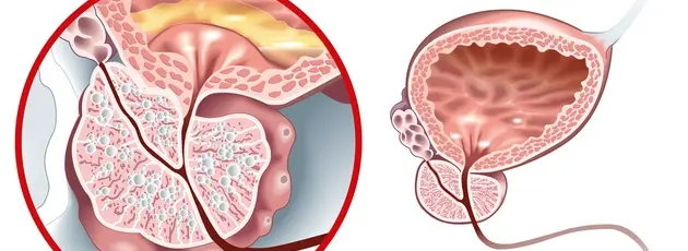 Benign prostatic hyperplasia treatment in Israel