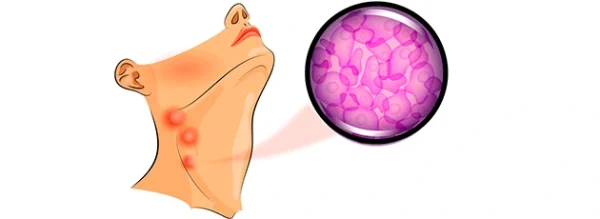 Лечение лимфомы в Израиле