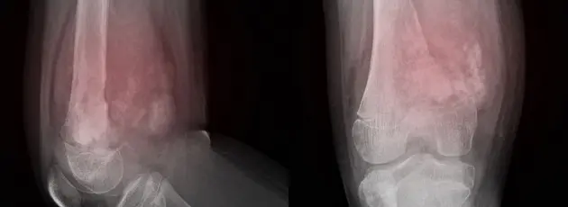 Ewing Sarcoma Treatment in Israel