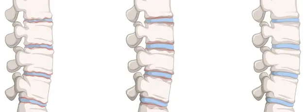 Spine Treatment in Israel