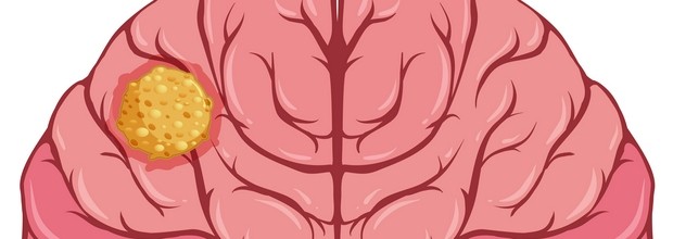 Brain Cyst treatment in Israel